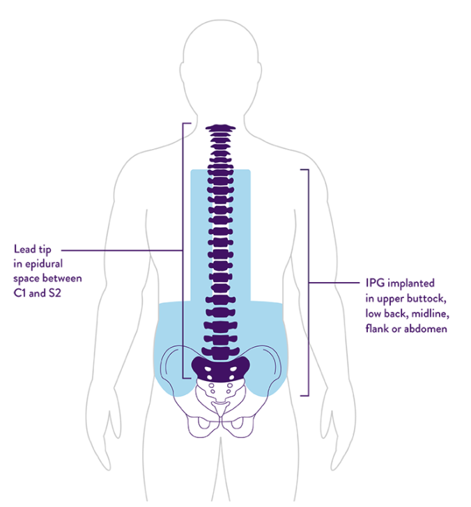 Is it Time to get a Spinal Cord Stimulator?