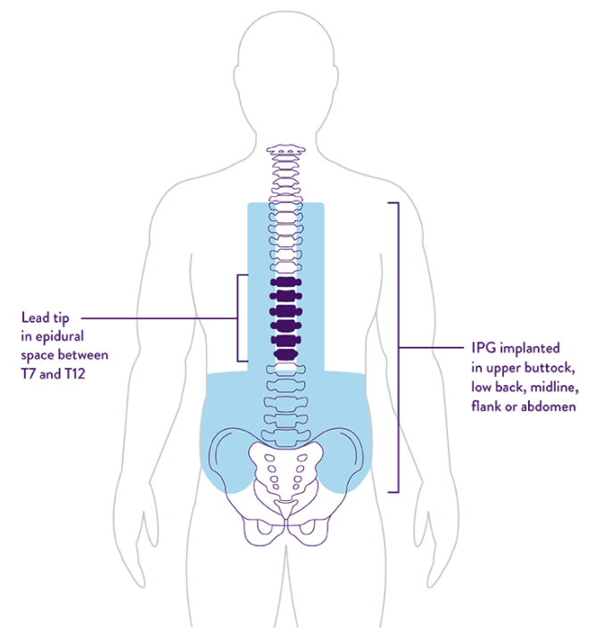 MRI Support—Protégé MRI™ & Prodigy MRI™ Abbott
