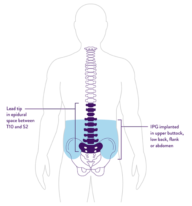 MRI Support—Proclaim™ DRG Abbott