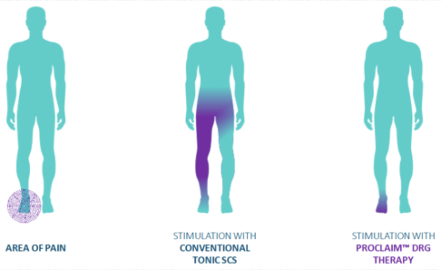 Proclaim™ DRG Therapy Abbott