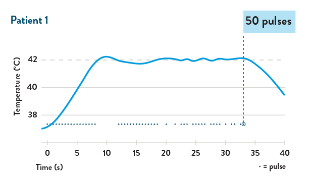 graph pulsed patient 1