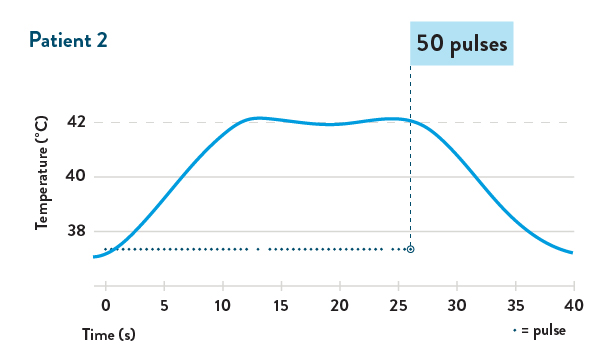 graph pulsed patient 2
