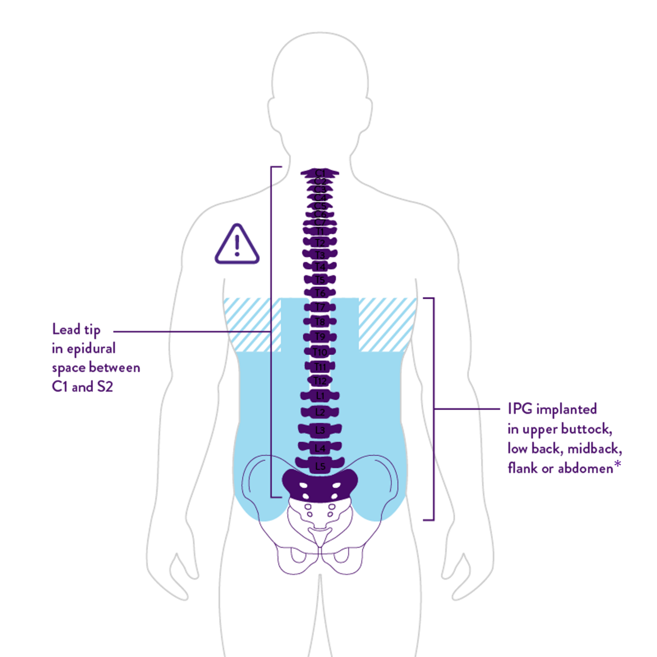 MRI Support—Eterna Abbott