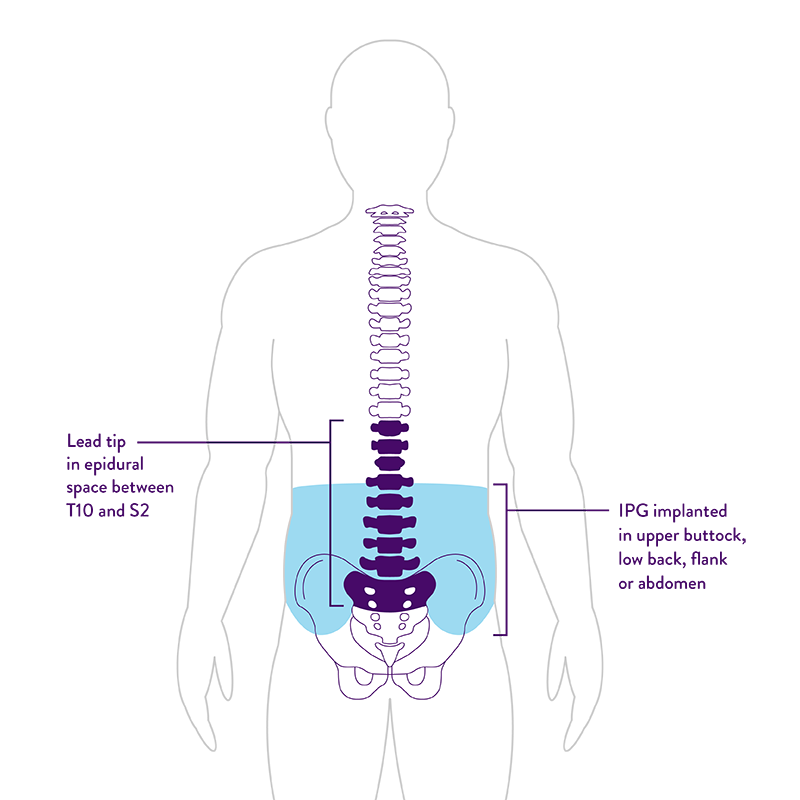 body graphic Showing IPG implant in lower back