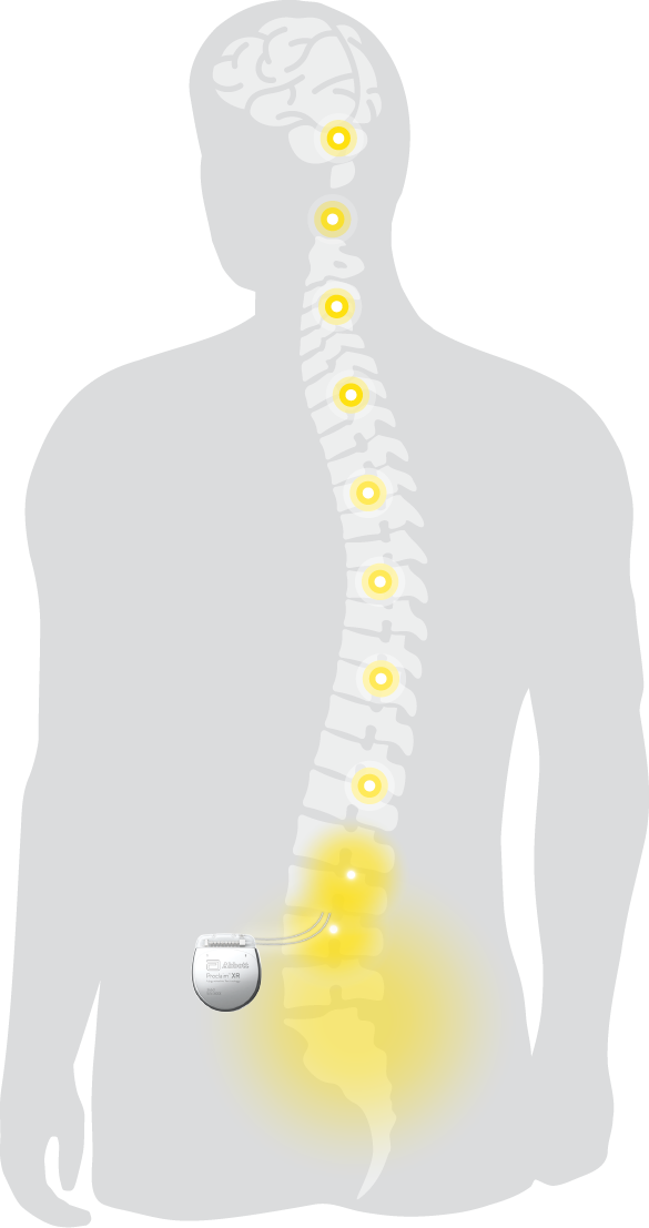 How Advanced Spinal Cord Stimulators Offer Drug-Free Relief of