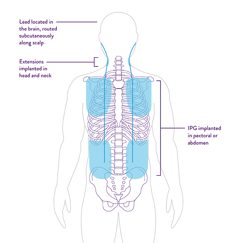 body graphic showing DBS Full system