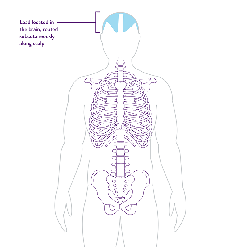 body graphic showing lead-only system