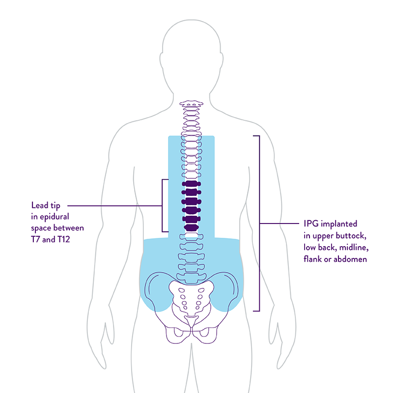 body graphic Showing IPG implant