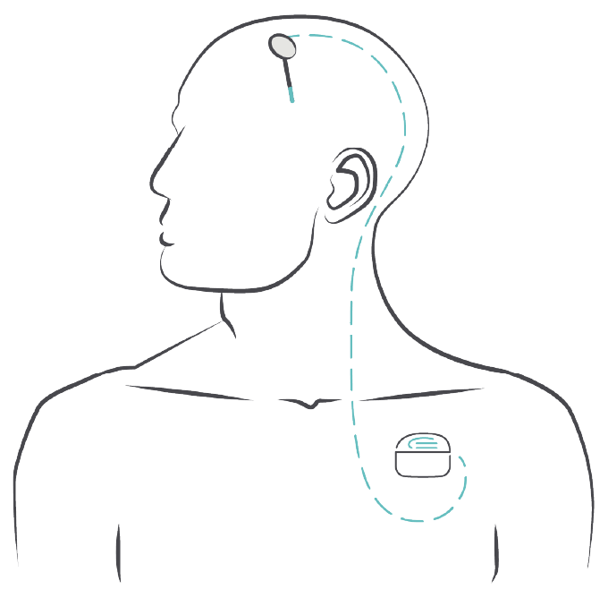 Diagram of man receiving DBS therapy